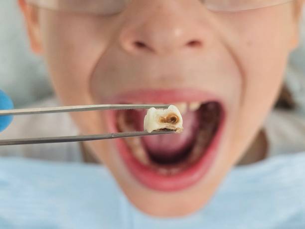 Best Emergency Dental Care for Broken or Chipped Teeth in Blossburg, PA